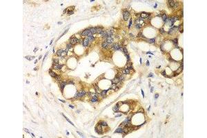 Immunohistochemistry of paraffin-embedded Human liver cancer using RPH3A Polyclonal Antibody at dilution of 1:100 (40x lens). (RPH3A Antikörper)
