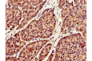 Immunohistochemistry of paraffin-embedded human ovarian cancer using ABIN7166771 at dilution of 1:100 (RBFA Antikörper  (AA 201-343))