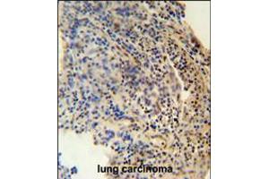 ZNF197 antibody immunohistochemistry analysis in formalin fixed and paraffin embedded human lung carcinoma followed by peroxidase conjugation of the secondary antibody and DAB staining. (ZNF197 Antikörper  (N-Term))