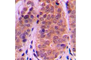 Immunohistochemical analysis of Histone Deacetylase 5 staining in human breast cancer formalin fixed paraffin embedded tissue section. (HDAC5 Antikörper  (C-Term))