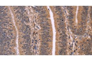 Immunohistochemistry of paraffin-embedded Human colon cancer using CLUAP1 Polyclonal Antibody at dilution of 1:50 (CLUAP1 Antikörper)