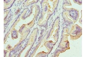 Immunohistochemistry of paraffin-embedded human prostate cancer using ABIN7157198 at dilution of 1:100 (Kallikrein 1 Antikörper  (AA 35-276))
