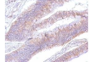 IHC-P Image eEF2 antibody detects eEF2 protein at cytosol on human colon by immunohistochemical analysis. (EEF2 Antikörper)