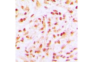 Immunohistochemical analysis of CDC16 staining in human lung cancer formalin fixed paraffin embedded tissue section. (CDC16 Antikörper  (C-Term))