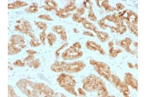 Formalin-fixed, paraffin-embedded human Prostate Carcinoma stained with AMACR / p504S Mouse Monoclonal Antibody (AMACR/1723). (AMACR Antikörper)