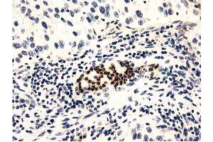 Immunohistochemical staining of paraffin-embedded Carcinoma of Human bladder tissue using anti-GAS7 mouse monoclonal antibody.