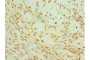 Immunohistochemistry of paraffin-embedded human breast cancer using ABIN7147272 at dilution of 1:100