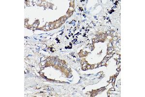 Immunohistochemistry of paraffin-embedded human lung cancer using OL Rabbit pAb (1671) at dilution of 1:100 (40x lens). (OLA1 Antikörper  (AA 297-396))