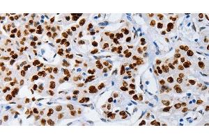 Immunohistochemistry of paraffin-embedded Human lung cancer using MUTYH Polyclonal Antibody at dilution of 1:60 (MUTYH Antikörper)
