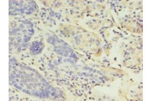 Immunohistochemistry of paraffin-embedded human gastric cancer using ABIN7158812 at dilution of 1:100 (LYZ Antikörper  (AA 19-148))
