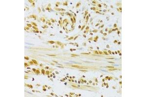 Immunohistochemistry of paraffin-embedded human gastric cancer using HMGB1 Antibody. (HMGB1 Antikörper  (AA 100-200))