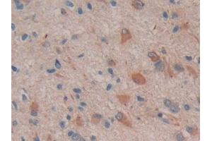 Detection of COX 2 in Human Glioma Tissue using Polyclonal Antibody to Cyclooxygenase-2 (COX 2) (COX2 Antikörper  (AA 418-589))