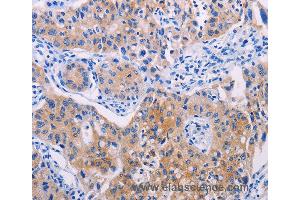 Immunohistochemistry of Human lung cancer using AGT Polyclonal Antibody at dilution of 1:30 (AGT Antikörper)