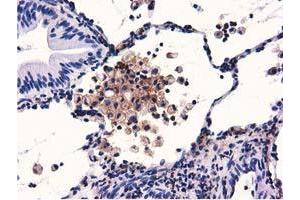 Immunohistochemical staining of paraffin-embedded Carcinoma of Human lung tissue using anti-GAS7 mouse monoclonal antibody. (GAS7 Antikörper)