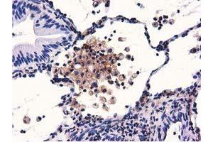 Immunohistochemical staining of paraffin-embedded Carcinoma of Human lung tissue using anti-GAS7 mouse monoclonal antibody.