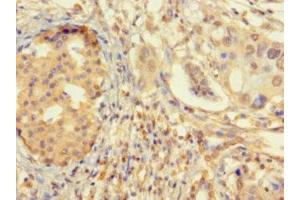 Immunohistochemistry of paraffin-embedded human pancreatic cancer using ABIN7176145 at dilution of 1:100