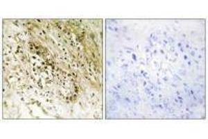 Immunohistochemistry analysis of paraffin-embedded human prostate carcinoma tissue, using PDZD2 antibody. (PDZD2 Antikörper)