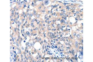 Immunohistochemistry of Human ovarian cancer using GRIN2D Polyclonal Antibody at dilution of 1:30