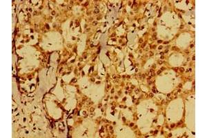 Immunohistochemistry of paraffin-embedded human breast cancer using ABIN7152575 at dilution of 1:100 (FAIM Antikörper  (AA 1-179))