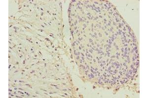 Immunohistochemistry of paraffin-embedded human cervical cancer using ABIN7157360 at dilution of 1:100 (Keratin 33B Antikörper  (AA 1-404))