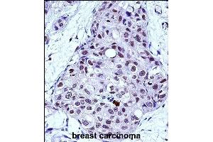 MYB Antibody (Center) (ABIN657911 and ABIN2846859) immunohistochemistry analysis in formalin fixed and paraffin embedded human breast carcinoma followed by peroxidase conjugation of the secondary antibody and DAB staining.