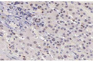 ABIN6266503 at 1/200 staining human liver carcinoma tissue sections by IHC-P.