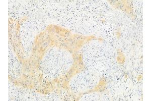 ABIN6257145 and ABIN6275079 at 1/100 staining human tongue carcinoma by IHC-P.