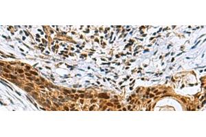 Immunohistochemistry of paraffin-embedded Human esophagus cancer tissue using NABP1 Polyclonal Antibody at dilution of 1:80(x200) (OBFC2A Antikörper)