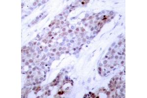 Immunohistochemistry of paraffin-embedded human breast carcinoma using Phospho-ATF4-S245 antibody (ABIN2987890). (ATF4 Antikörper  (pSer245))