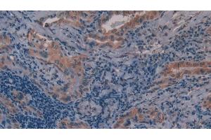 Detection of MMP11 in Human Thyroid cancer Tissue using Polyclonal Antibody to Matrix Metalloproteinase 11 (MMP11) (MMP11 Antikörper  (AA 277-488))