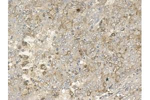 ABIN6256710 and ABIN6267163 at 1/100 staining human melanoma by IHC-P.