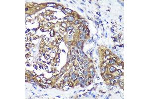 Immunohistochemistry of paraffin-embedded Human lung cancer using  Rabbit pAb (ABIN7265603) at dilution of 1:100 (40x lens). (ANKLE2 Antikörper  (AA 350-450))