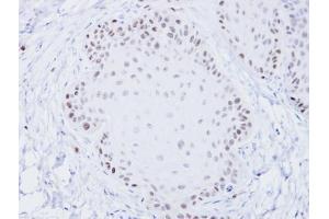 IHC-P Image Immunohistochemical analysis of paraffin-embedded Cal27 xenograft, using BLM, antibody at 1:100 dilution. (BLM Antikörper  (C-Term))