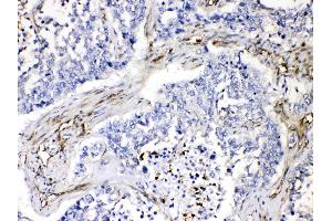 VASP was detected in paraffin-embedded sections of human lung cancer tissues using rabbit anti- VASP Antigen Affinity purified polyclonal antibody (Catalog # ) at 1 µg/mL.