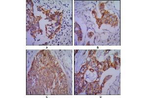 Immunohistochemical analysis of paraffin-embedded human lung cancer (A), colon cancer (B), ovarian cancer (C) and mammary cancer(D), using CDH2 mouse mAb with DAB staining. (N-Cadherin Antikörper)