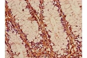 Immunohistochemistry of paraffin-embedded human colon cancer using ABIN7153058 at dilution of 1:100 (Foxk1 Antikörper  (AA 621-730))
