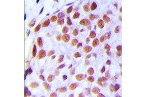 Immunohistochemical analysis of TAF5L staining in human breast cancer formalin fixed paraffin embedded tissue section.