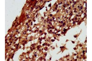 IHC image of ABIN7167616 diluted at 1:300 and staining in paraffin-embedded human melanoma performed on a Leica BondTM system. (RGS6 Antikörper  (AA 177-262))
