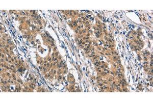 Immunohistochemistry of paraffin-embedded Human gastric cancer tissue using BNIP3L Polyclonal Antibody at dilution 1:40 (BNIP3L/NIX Antikörper)