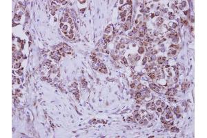 IHC-P Image Immunohistochemical analysis of paraffin-embedded human breast cancer, using MUSK, antibody at 1:250 dilution. (MUSK Antikörper  (N-Term))
