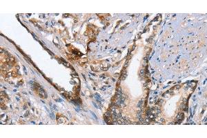 Immunohistochemistry of paraffin-embedded Human prostate cancer using MAD2L1BP Polyclonal Antibody at dilution of 1:65 (MAD2L1BP Antikörper)