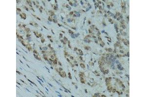 Immunohistochemistry of paraffin-embedded Human colon carcinoma using GABPA Polyclonal Antibody at dilution of 1:100 (40x lens). (GABPA Antikörper)