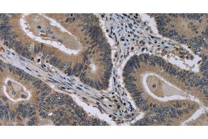 Immunohistochemistry of paraffin-embedded Human colon cancer using MCM3AP Polyclonal Antibody at dilution of 1:30 (GANP Antikörper)