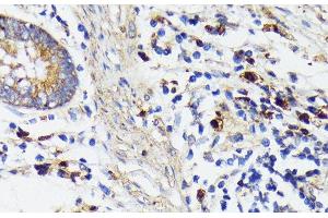Immunohistochemistry of paraffin-embedded Human colon carcinoma using TREM2 Polyclonal Antibody at dilution of 1:200 (40x lens). (TREM2 Antikörper)