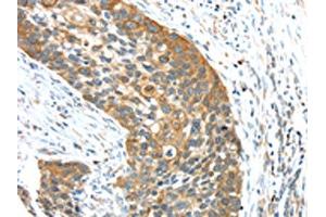 The image on the left is immunohistochemistry of paraffin-embedded Human esophagus cancer tissue using ABIN7131474(TRIM16 Antibody) at dilution 1/35, on the right is treated with fusion protein. (TRIM16 Antikörper)