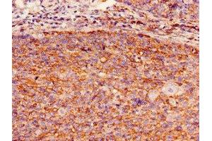 Immunohistochemistry of paraffin-embedded human pancreatic cancer using ABIN7154773 at dilution of 1:100