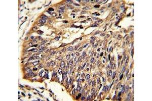 IHC analysis of FFPE human lung carcinoma stained with MyD88 antibody (MYD88 Antikörper  (AA 136-164))