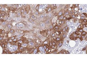 ABIN6274028 at 1/100 staining Human Head and neck cancer tissue by IHC-P. (PD-1 Antikörper  (Internal Region))