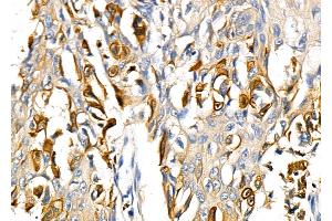 ABIN6264786 and ABIN6278631 at 1/100 staining Human esophageal cancer by IHC-P. (RNF19A Antikörper  (N-Term))