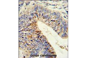 Formalin-fixed and paraffin-embedded human colon carcinoma reacted with ADAMDEC1 Antibody (N-term), which was peroxidase-conjugated to the secondary antibody, followed by DAB staining. (ADAMDEC1 Antikörper  (N-Term))